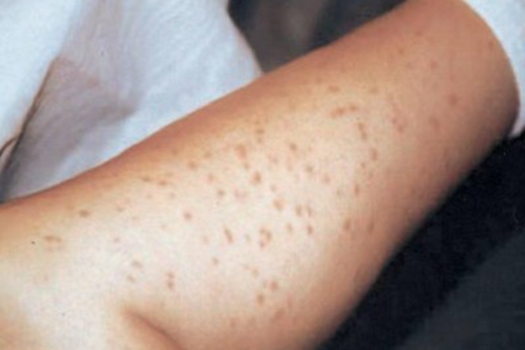 色素性荨麻疹小腿丘疹图