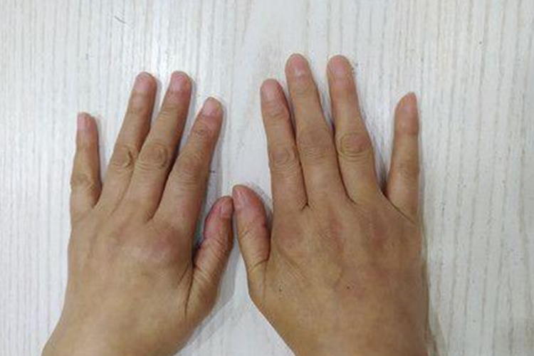 类风湿关节炎初期手关节红肿图