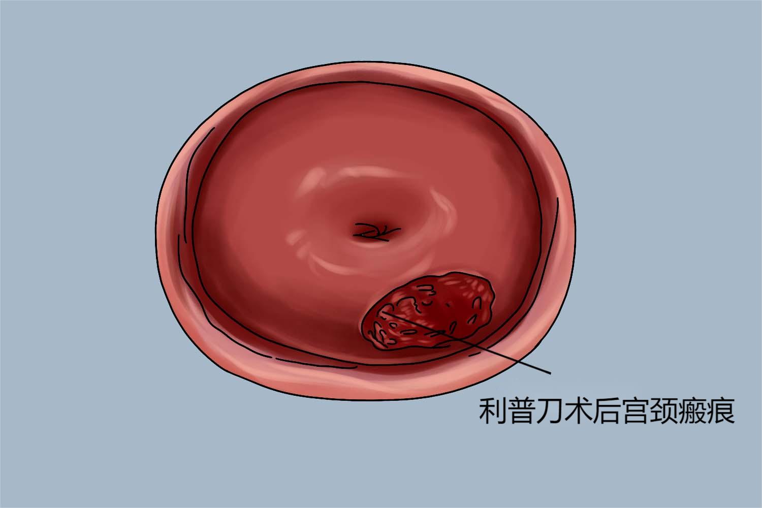 利普刀术后的宫颈图片图片