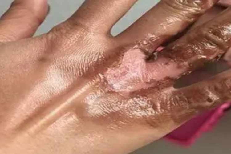 电烧伤手背脱皮图 电烧伤手背脱皮图