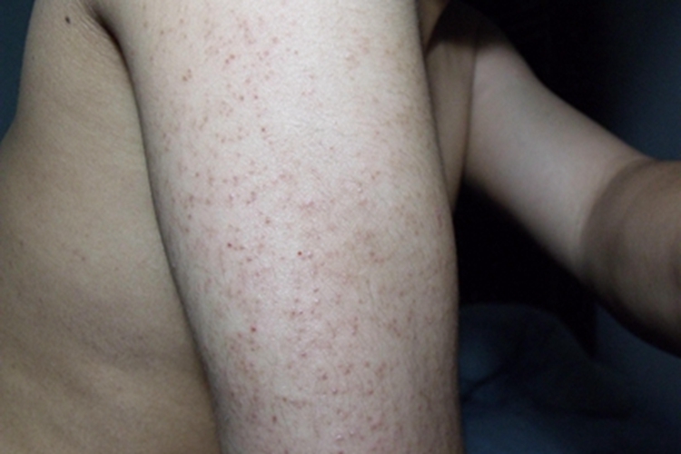 毛囊性鱼鳞病胳膊出现丘疹图