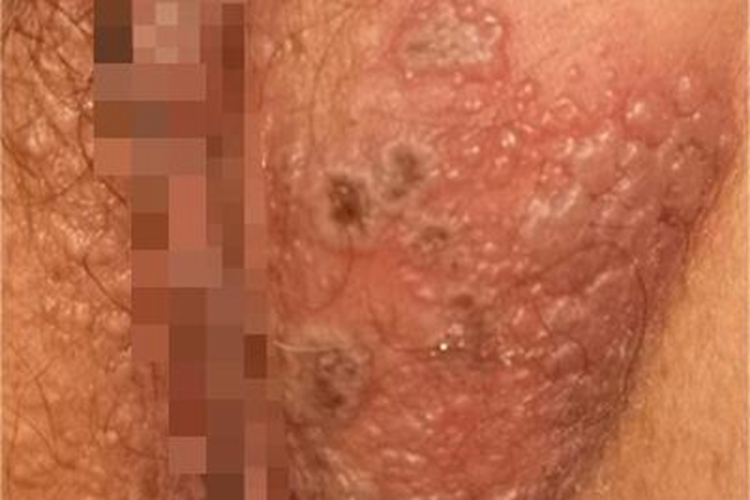 女性原发性生殖器疱疹结痂图 女性原发性生殖器疱疹结痂图