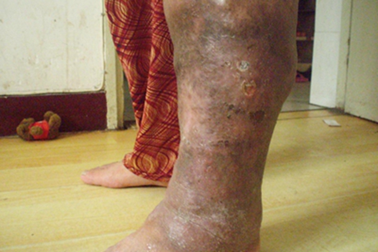 湿性坏疽小腿脱屑图 湿性坏疽小腿脱屑图