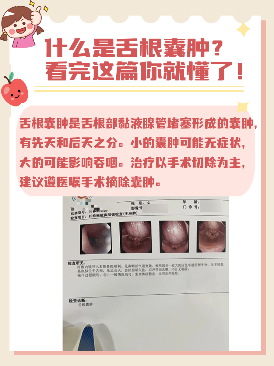 什么是舌根囊肿？看完这篇你就懂了！