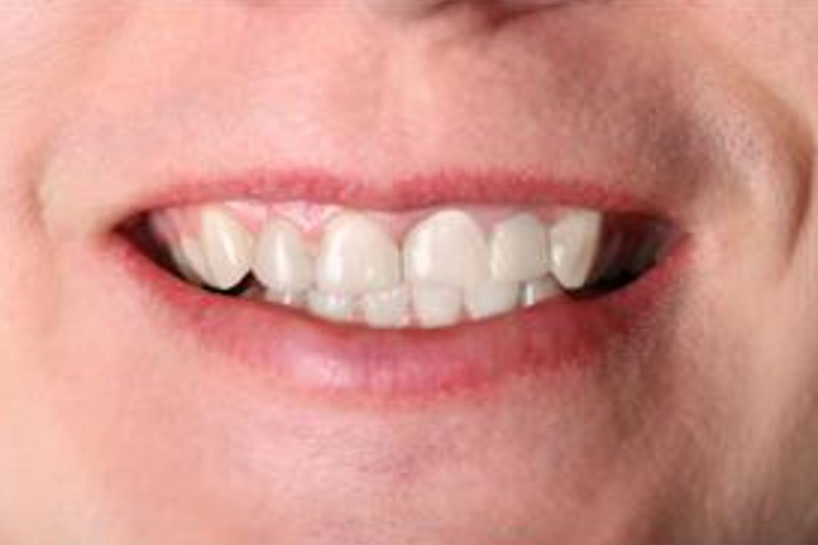 门牙嵌体修复后图