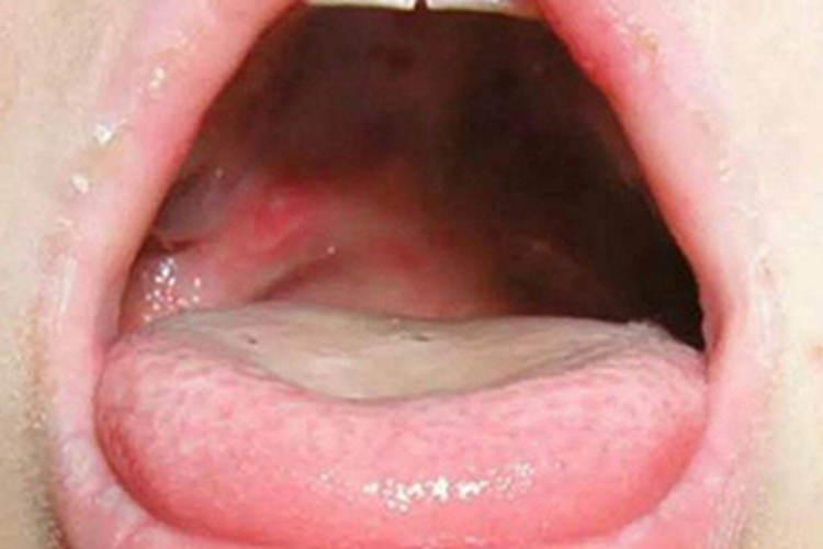 一岁半宝宝口腔图