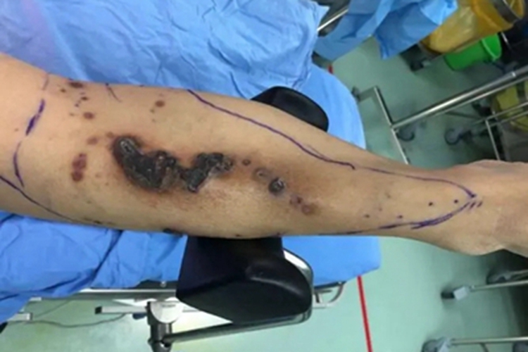 皮肤溃疡小腿症状图 皮肤溃疡小腿症状图