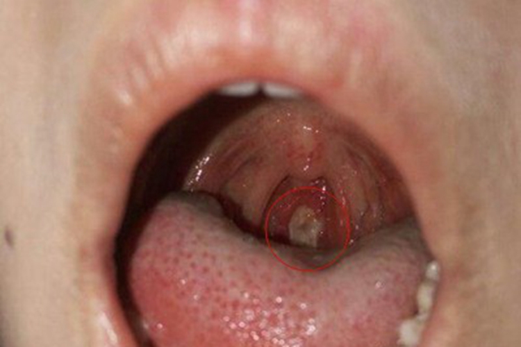 淋菌性咽炎咽喉溃疡图