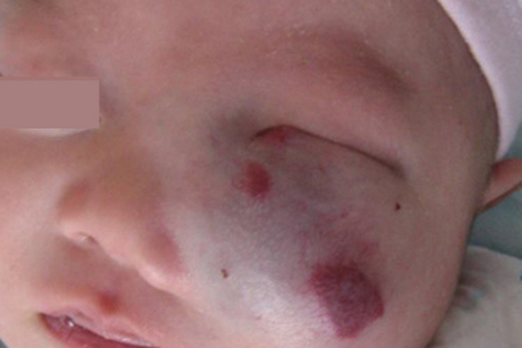 混合型婴儿血管瘤面部肿块图 混合型婴儿血管瘤面部肿块图