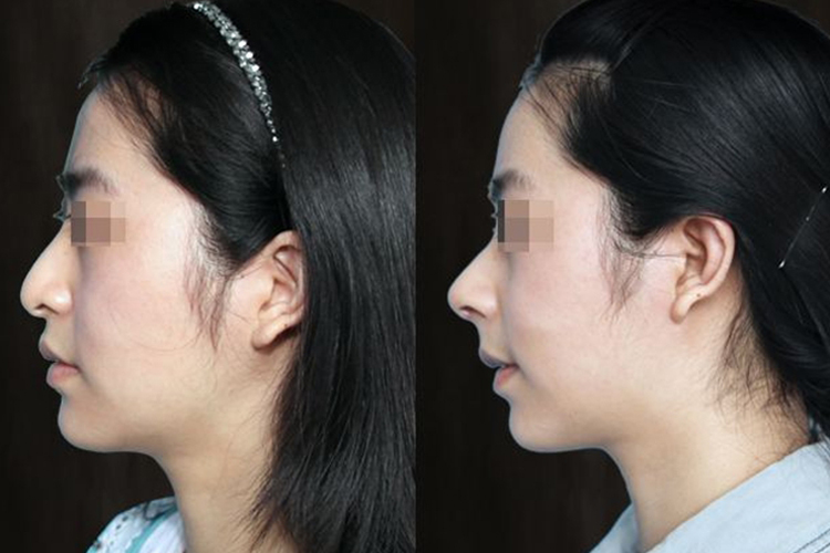 鹰钩鼻整形前后对比图