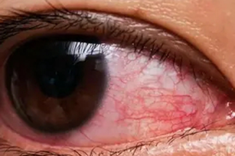 慢性细菌性结膜炎血丝图