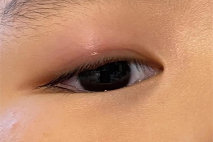 眶蜂窝织炎眼周变肿图