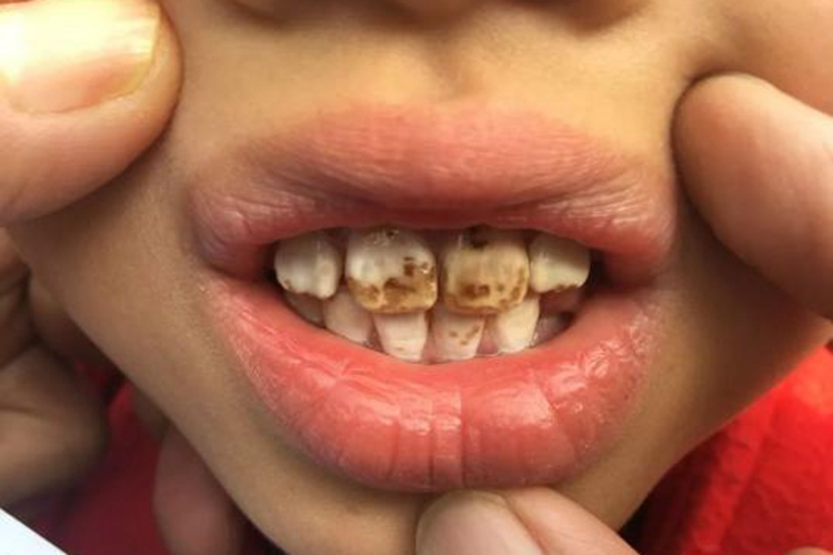 牙齿色素沉着图