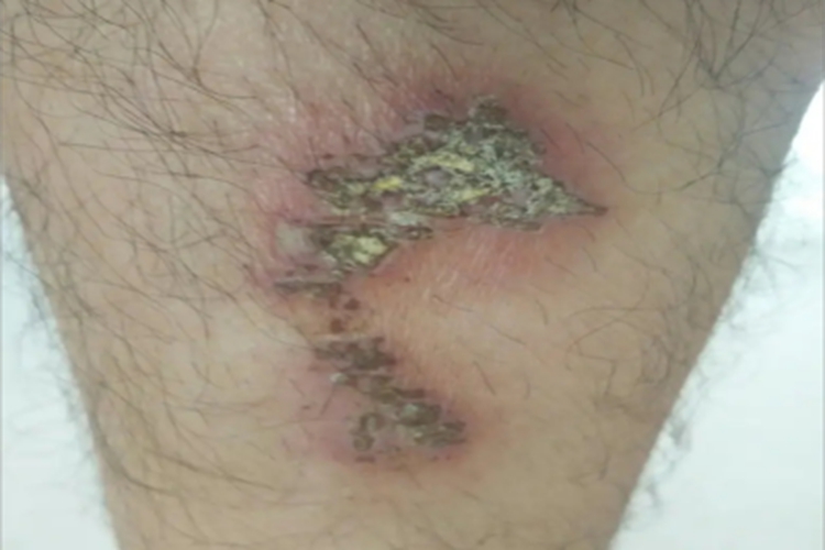 深脓疱疮小腿结痂图