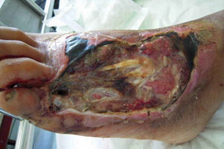 炭疽病结痂图 炭疽病结痂图