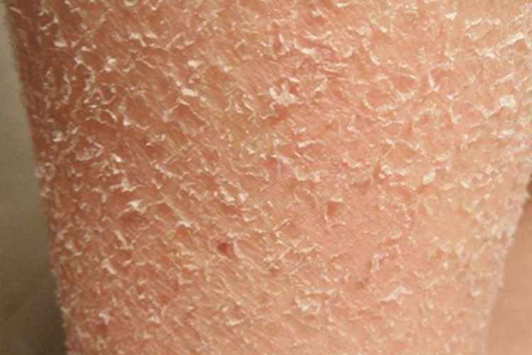 皮肤干燥症胳膊脱皮图