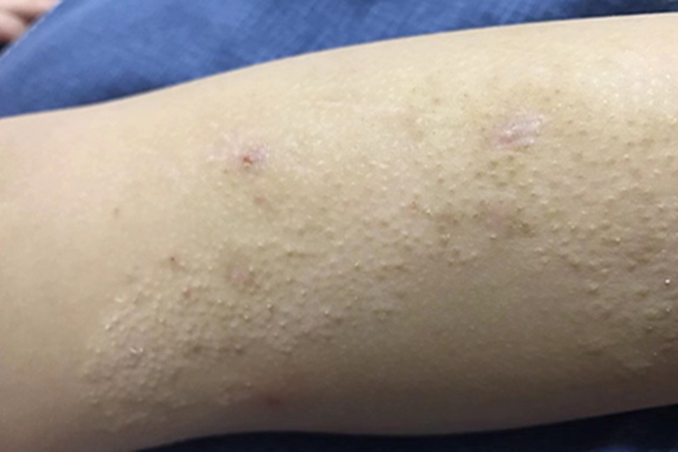 光泽苔藓丘疹图 光泽苔藓丘疹图