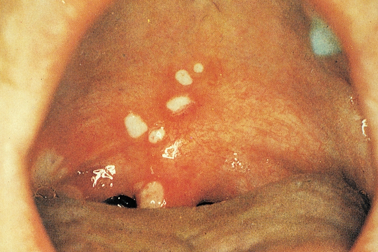 疱疹破溃后形成黄色溃疡图