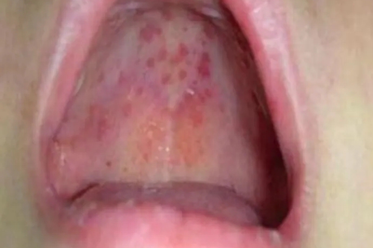 手足口病口腔丘疹图 手足口病口腔丘疹图