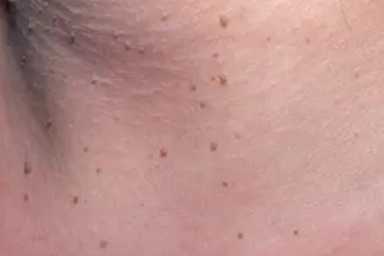 皮肤平滑肌瘤丘疹图 皮肤平滑肌瘤丘疹图