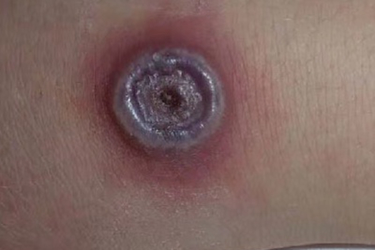 牛痘起大水疱图