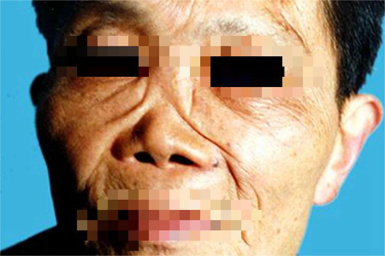 男性三期梅毒鼻部变形图