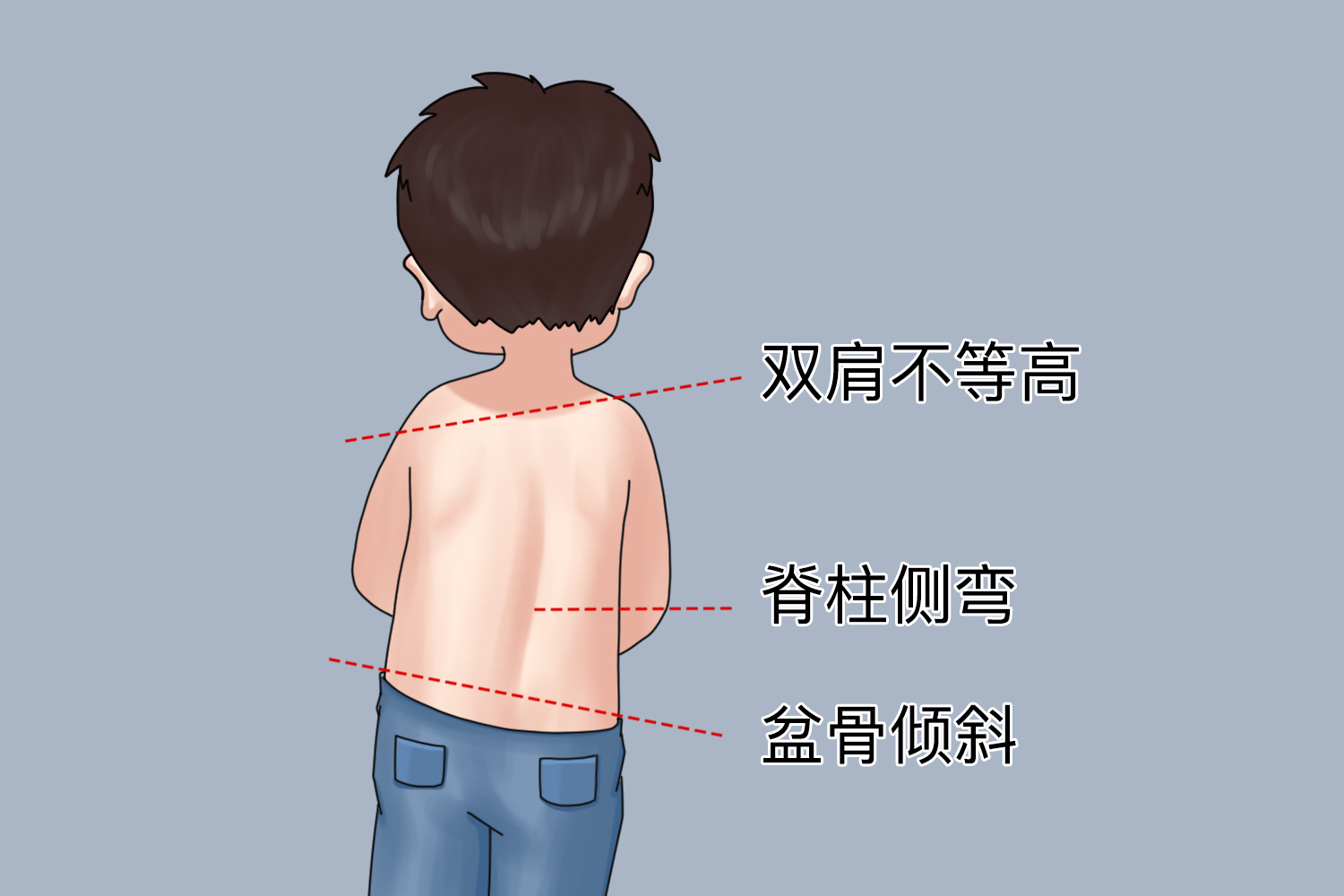 肩胛骨一高一低图片图片