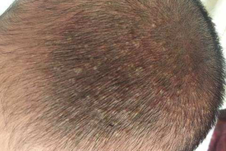 新生儿皮脂腺增生头皮长小疙瘩图