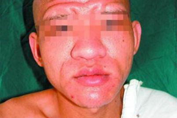 原发性骨膜增生厚皮症皮肤增厚图