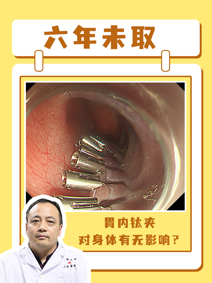 六年未取，胃内钛夹对身体有无影响？