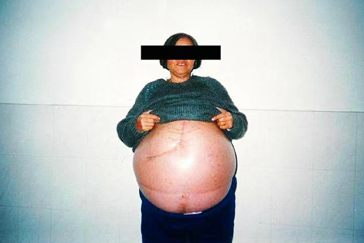 血吸虫病腹水图 血吸虫病腹水图