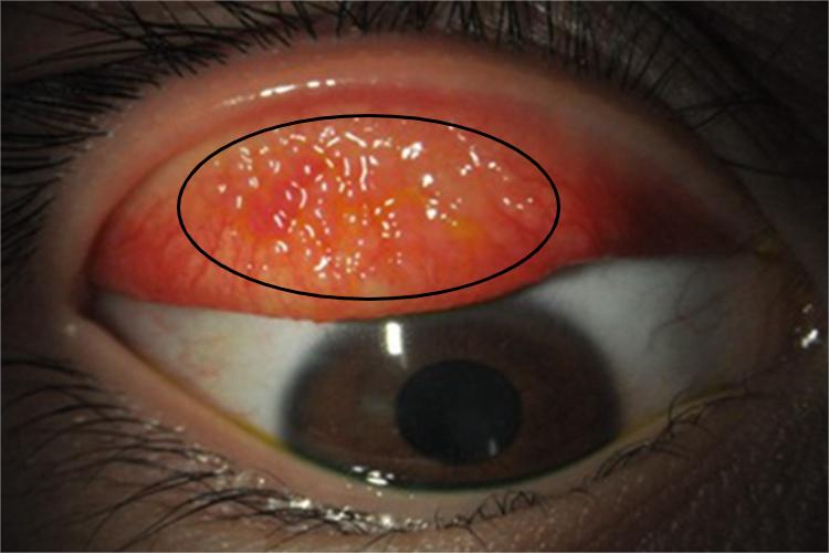 滤泡性结膜炎结膜疙瘩图 滤泡性结膜炎结膜疙瘩图
