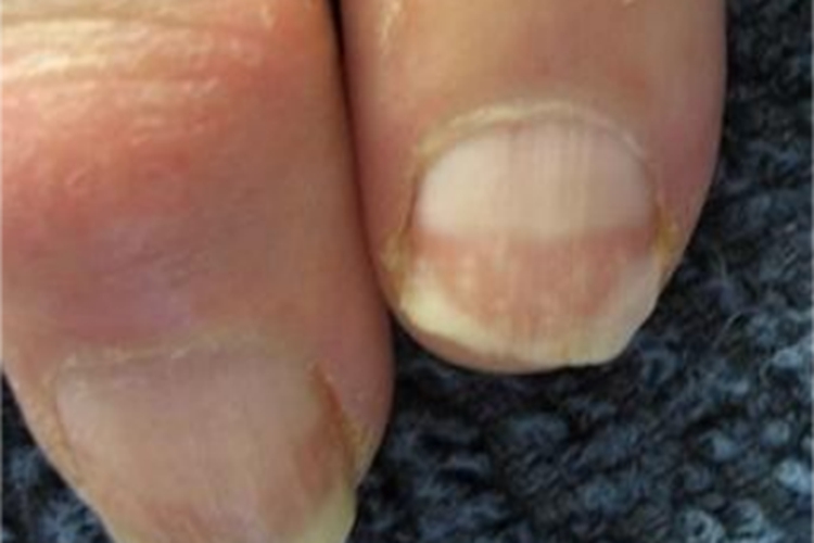 缺铁性贫血手指甲症状图