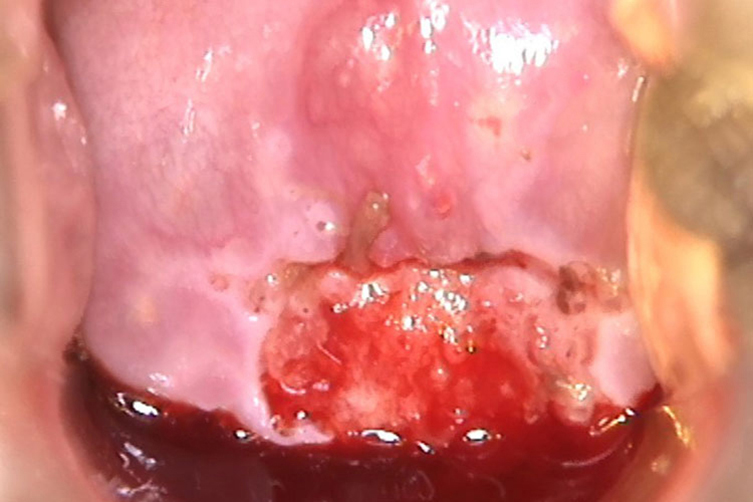 宫颈癌早期阴道流血图