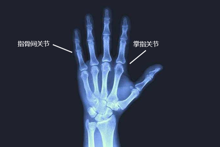 手指关节x光图