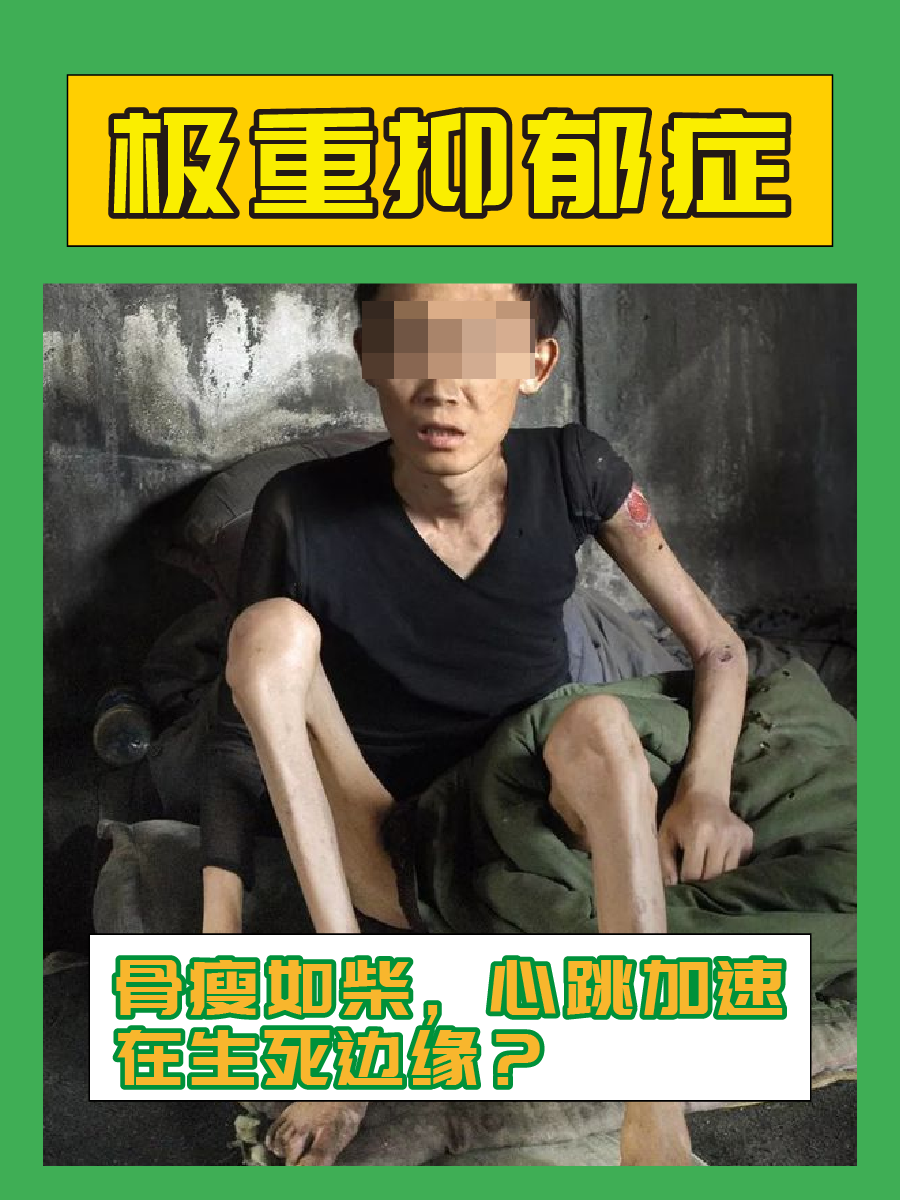 极重抑郁症:骨瘦如柴,心跳加速,在生死边缘?