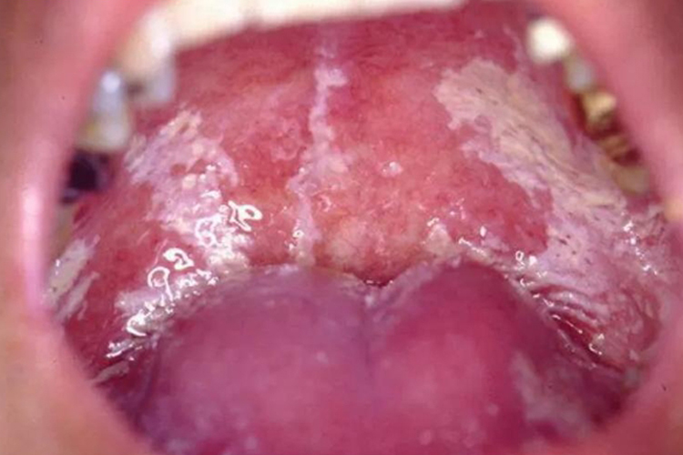 HIV口腔念珠菌感染红斑图