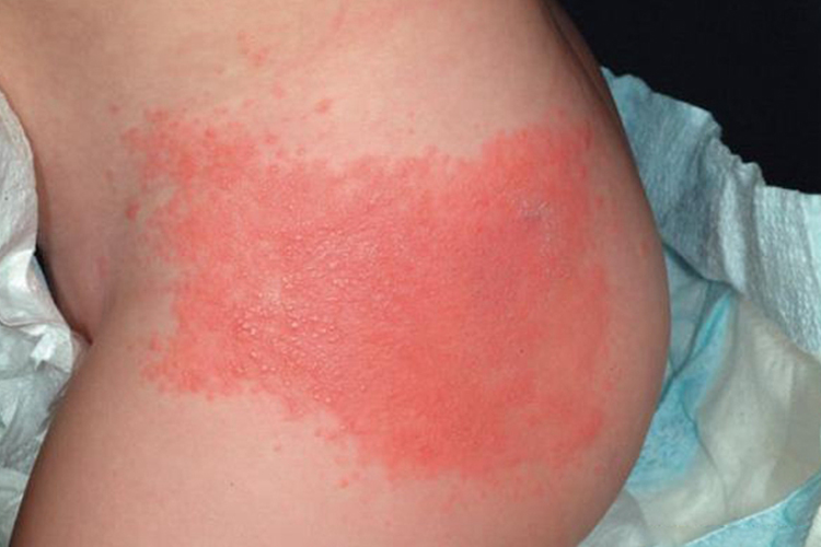 宝宝臀部尿布皮炎红斑丘疹图