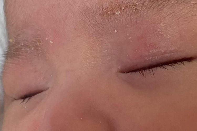 干性湿疹白色皮屑图