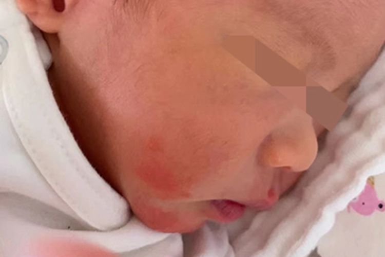新生儿中毒性红斑口周红斑图 新生儿中毒性红斑口周红斑图