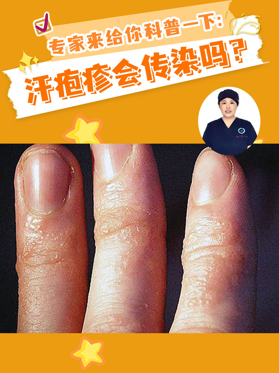 专家来给你科普一下：汗疱疹会传染吗？