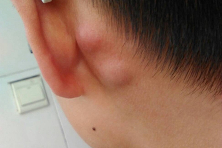 风疹耳后症状图