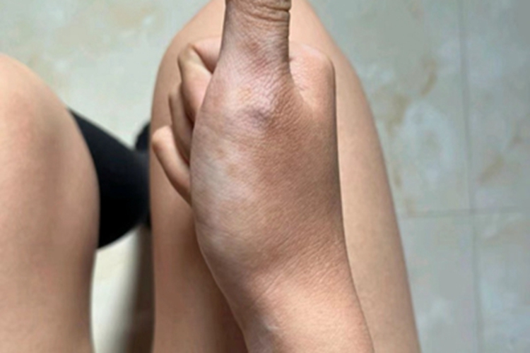 进展期节段型白癜风白斑图