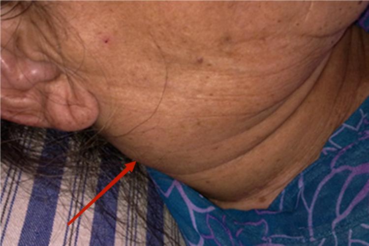 艾滋病急性感染期侧颈症状图 艾滋病急性感染期侧颈症状图