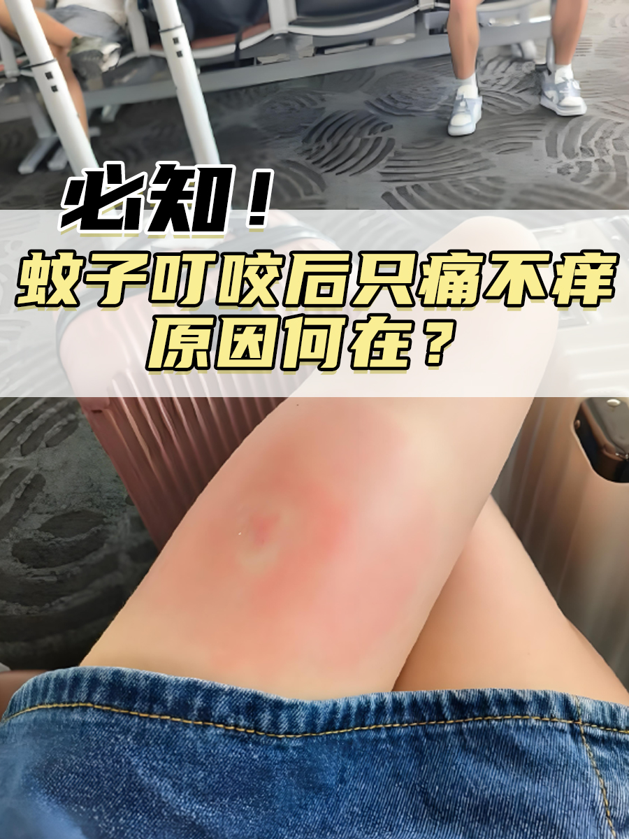 必知!蚊子叮咬后只痛不痒原因何在?