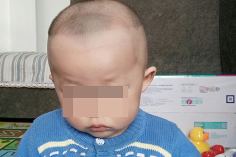 佝偻病宝宝冠状缝凹陷图