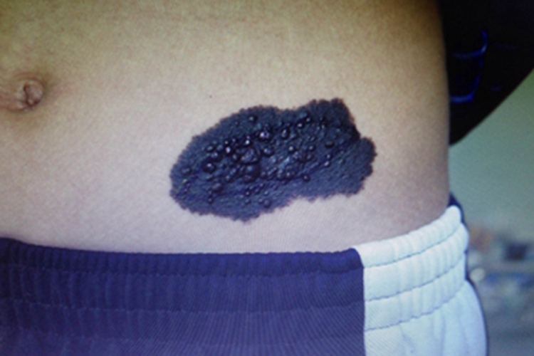 复合痣腹部黑斑图 复合痣腹部黑斑图