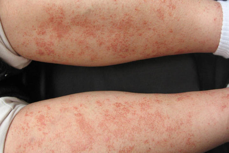 特发性血小板减少性紫癜图