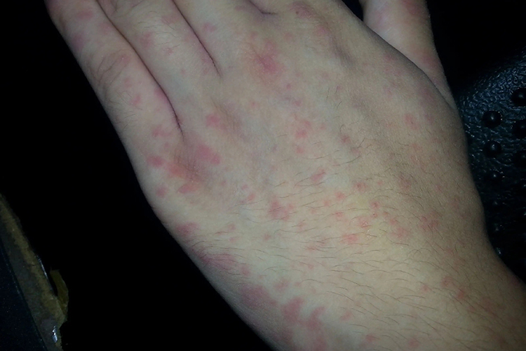 结核皮试手上有红斑图