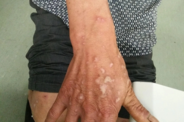 光化性痒疹胳膊有疙瘩图 光化性痒疹胳膊有疙瘩图